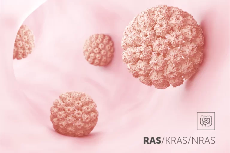 Detecția mutațiilor în genele All RAS (KRAS și NRAS) în cancerul colorectal (CRC)