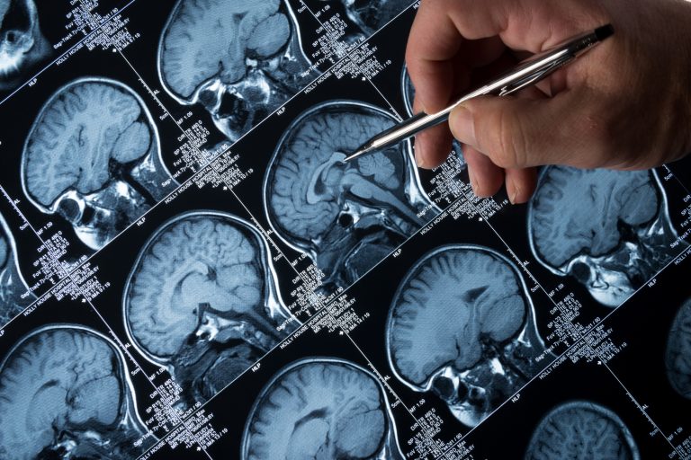 Panel de Epilepsie: detectează rapid simptomele, prezice prognosticul și progresia bolii