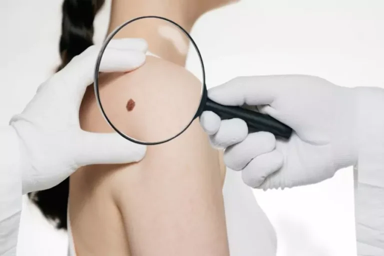 Screeningul pentru cancerul de piele: când și de ce este important