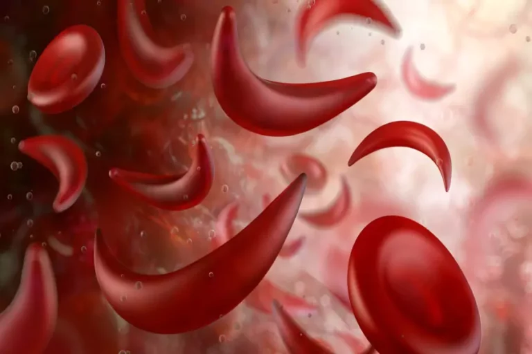Anemia falciformă (siclemia): o boală genetică a sângelui cu implicații severe
